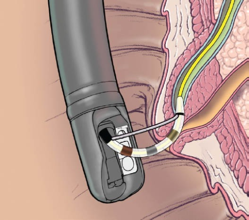 Outcomes of Dexmedetomidine During ERCP on Post-ERCP Pancreatitis